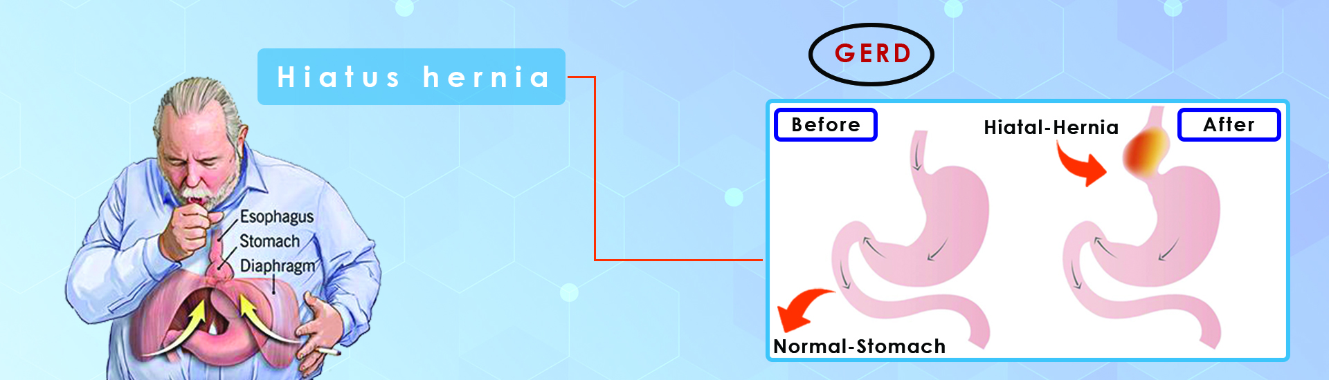 Laparoscopic Hernia Surgery in Ahmedabad