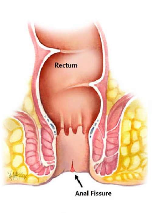 Anal Fissure Treatment In Ahmedabad, Fistula Surgery in Ahmedabad, Fissure & Fistula Treatment in Ahmedabad, Fistula Surgery in Ahmedabad