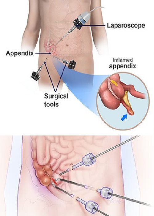 Appendix Doctor In Gujarat