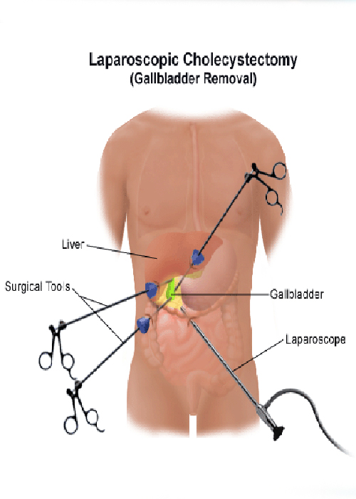 Laparoscopic Gallbladder Surgeon In Ahmedabad, Laparoscopic Gallbladder Surgeon In Gujarat