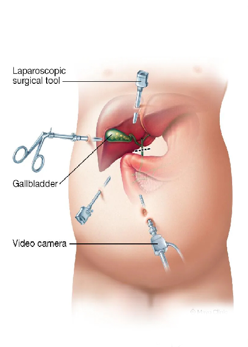 Gallbladder Stone Removal In Ahmedabad, Gallbladder Surgeon In Ahmedabad, Gallbladder Surgeon Near Me, Gallbladder Surgeon In Satellite