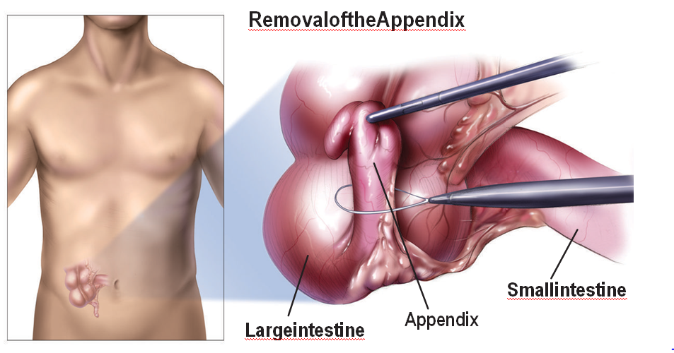 laparoscopic appendectomy recovery